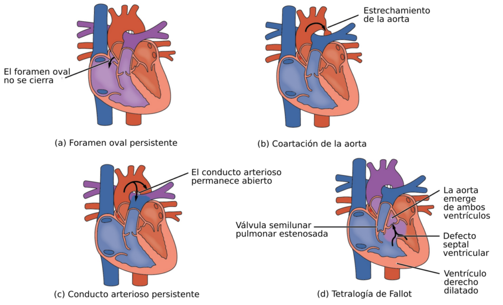 2009 Congenital Heart Defects-es